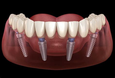 clearchoice fort washington|Full Mouth Dental Implants Near Me in Fort Washington,。